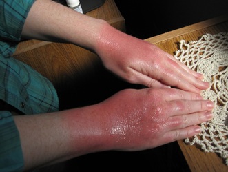 Sunburned hands from a paddle in South Florida